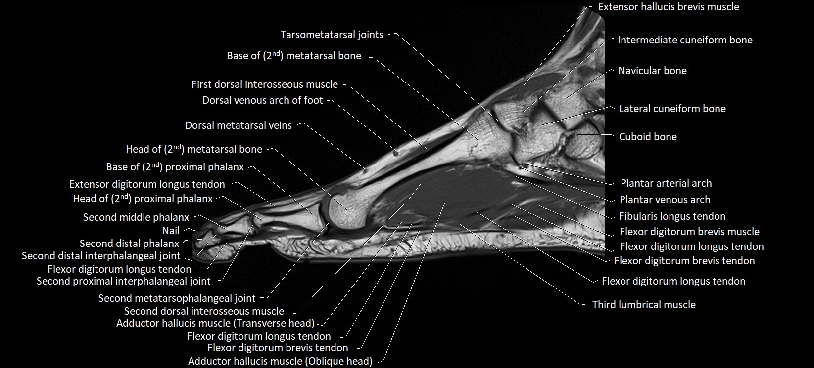 MRI foot sagittal labelled cross sectional anatomy image  13.webp